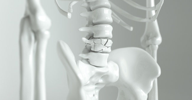 Osteoporose © Shutterstock