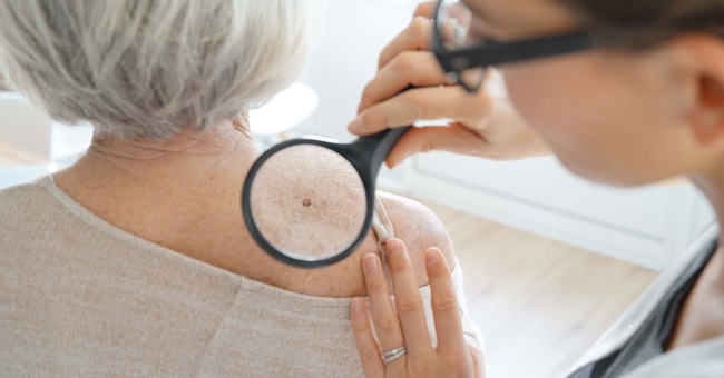 Hautkrebs © shutterstock