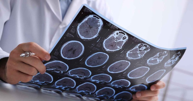 Sklerose © Shutterstock