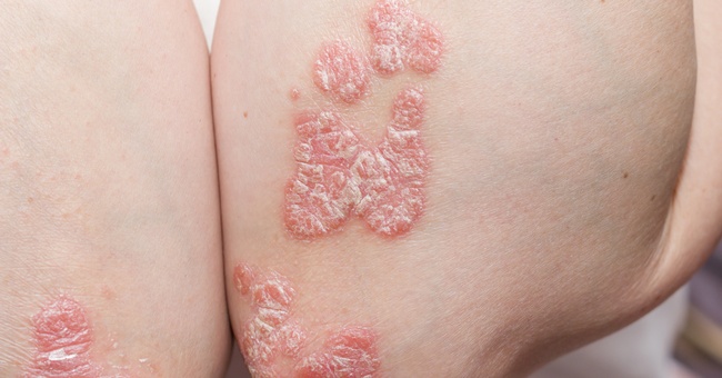 Ein Hautausschlag bei Psoriasis. © Shutterstock