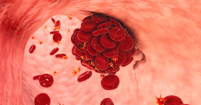 Illustration für ein Blutgerinnsel. © Shutterstock