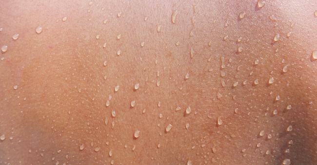 Als Hyperhidrose bezeichnet man eine &uuml;berm&auml;&szlig;ige Schwei&szlig;produktion. Je nach Auspr&auml;gung unterscheidet man verschiedene Schweregrade (Grad I-III). &copy; Shutterstock