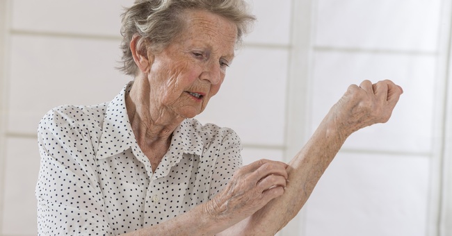 Eine ältere Frau leidet unter Juckreiz und kratzt sich an den Unterarmen. © Shutterstock