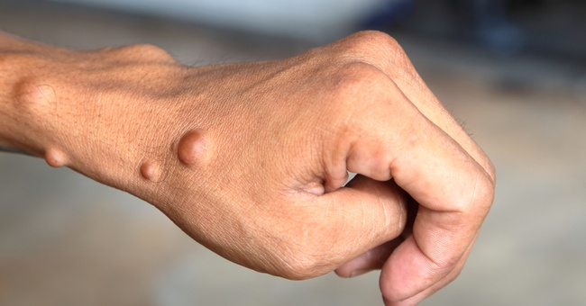 Knotige Tumorbildung auf der Hand. © Shutterstock