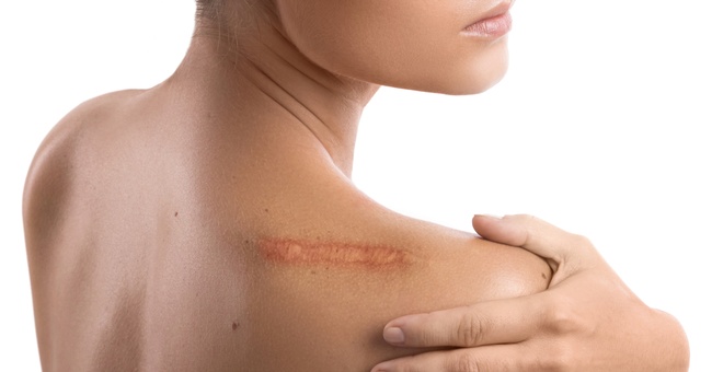 Auf der Schulter einer Frau ist eine große Narbe zu sehen. © Shutterstock