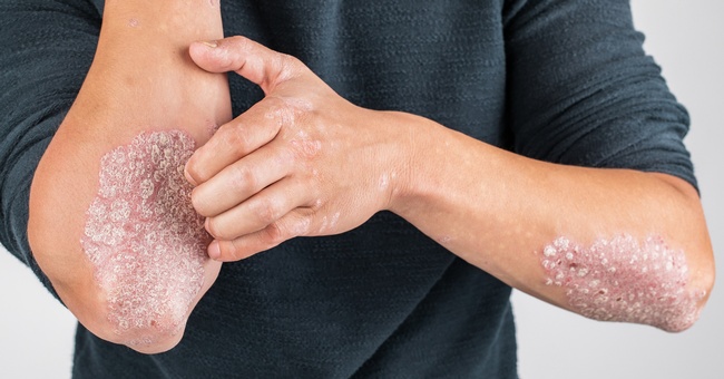 Ein Mann leidet auf den Armen unter Schuppenflechte. &copy; Shutterstock