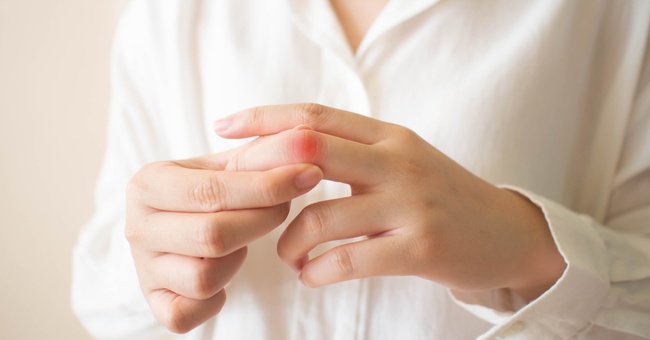 Eine Frau hält ihren geschwollenen Finger in die Kamera. © Shutterstock