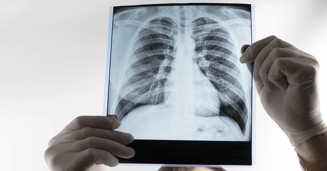 Arzt hält Röntgenbild einer Lunge in den Händen. © Shutterstock