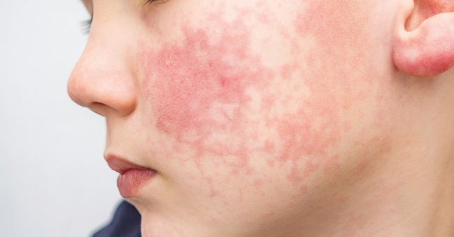 Kind mit sichtbarem Ausschlag im Gesicht.  © iStock