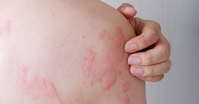 Urtikaria © Shutterstock