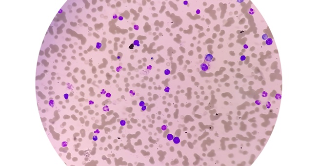 Morbus Waldenström © Shutterstock