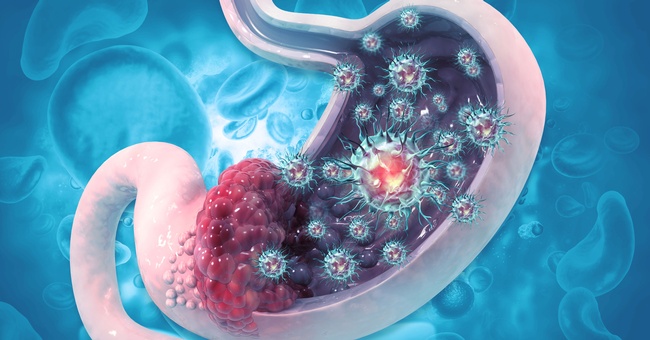 Magenkrebs © Shutterstock