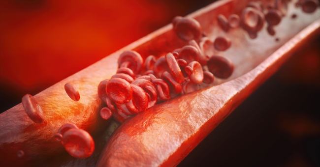 Atherosklerose © Shutterstock