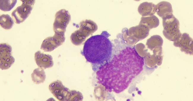 Symbolbild Myelofibrose © Shutterstock