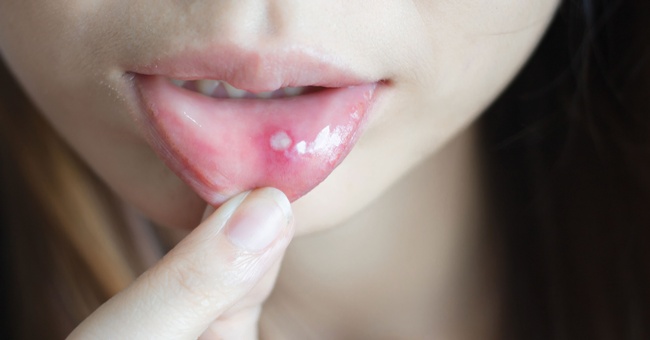 Aphthen ähneln zwar einer Herpes-Infektion, sind aber im Gegensatz dazu nicht ansteckend und heilen meist von selbst ab.  © Shutterstock