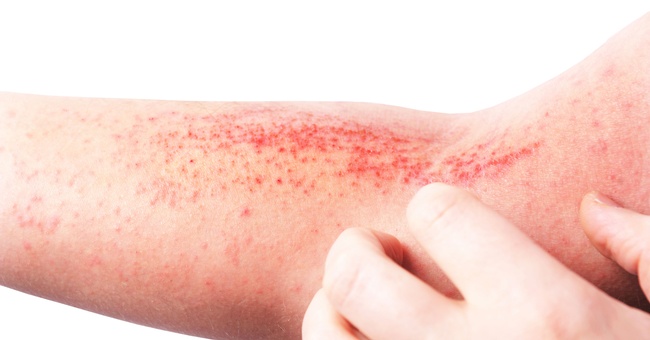 Atopische Dermatitis © Shutterstock