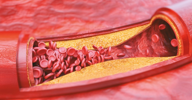 Bei der Atherosklerose lagert sich in den W&auml;nden der Arterien fetthaltige Substanz (atherosklerotische Plaques) ab, die den Blutfluss behindert und damit die N&auml;hr- und Sauerstoffversorgung des distalen Gewebes kontinuierlich verschlechtert. &copy; Shutterstock