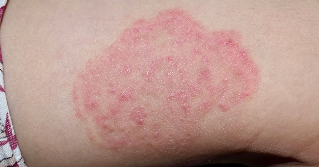 Dermatophyten © Shutterstock