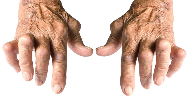 Arthritis © Shutterstock