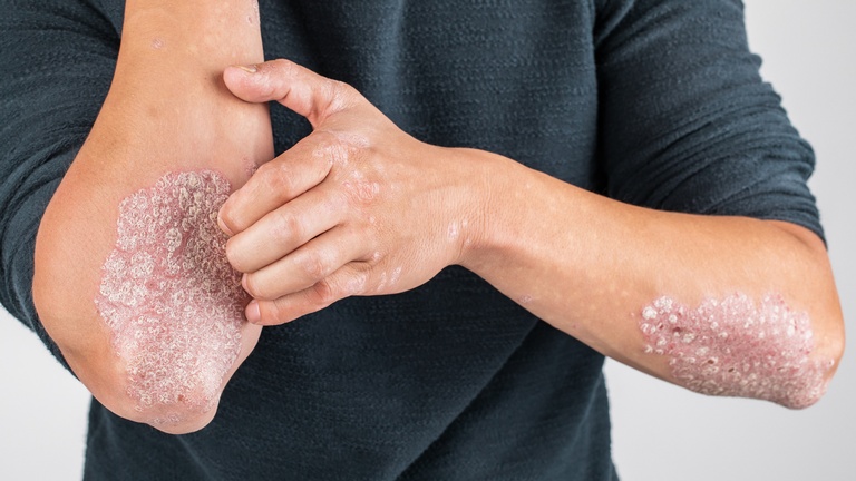 Ein Mann leidet auf den Armen unter Schuppenflechte. &copy; Shutterstock