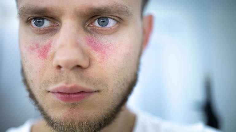 Systemischer Lupus erythematodes &copy; Shutterstock