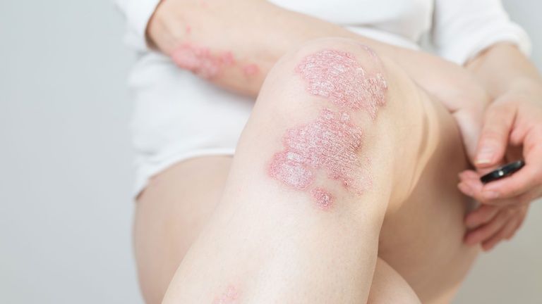 Psoriasis &copy; Shutterstock