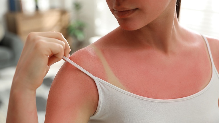 Frau mit Sonnenbrand © Shutterstock