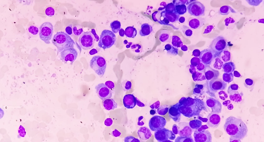 multiple Myelom © shutterstock