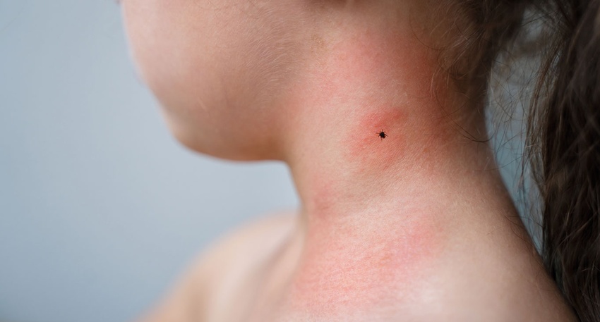 Zeckenstich &copy; Shutterstock