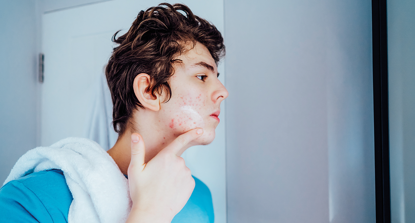 Akne bei Jugendlichem © iStock