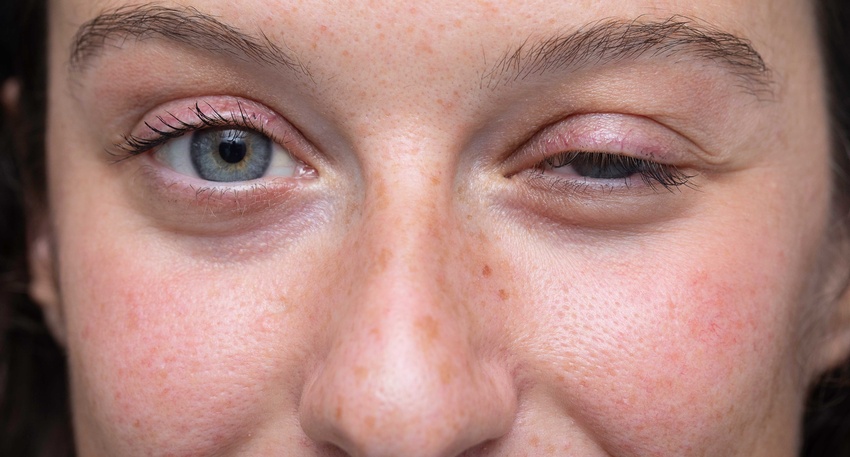 Myasthenia gravis © Shutterstock