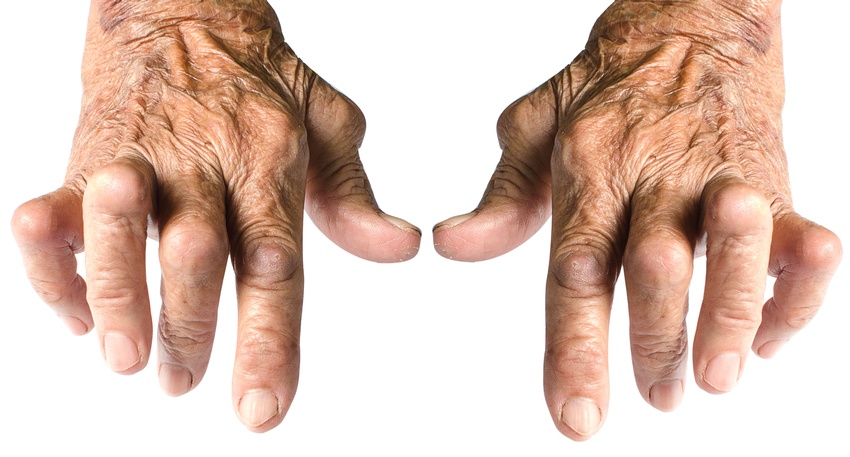 Arthritis &copy; Shutterstock