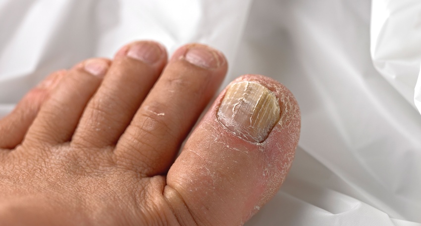 Nagelpilz sollte früh­zeitig und konsequent therapiert werden, da sich die Erreger sonst weiter ausbreiten und die Nagelplatte zerstören können. © iStock