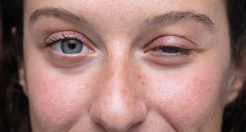 Bei der okularen Mysthenia gravis nimmt der Tonus der Augenmuskulatur ab, wodurch die Augenlider der Erkrankten herabhängen (Ptosis). © Shutterstock