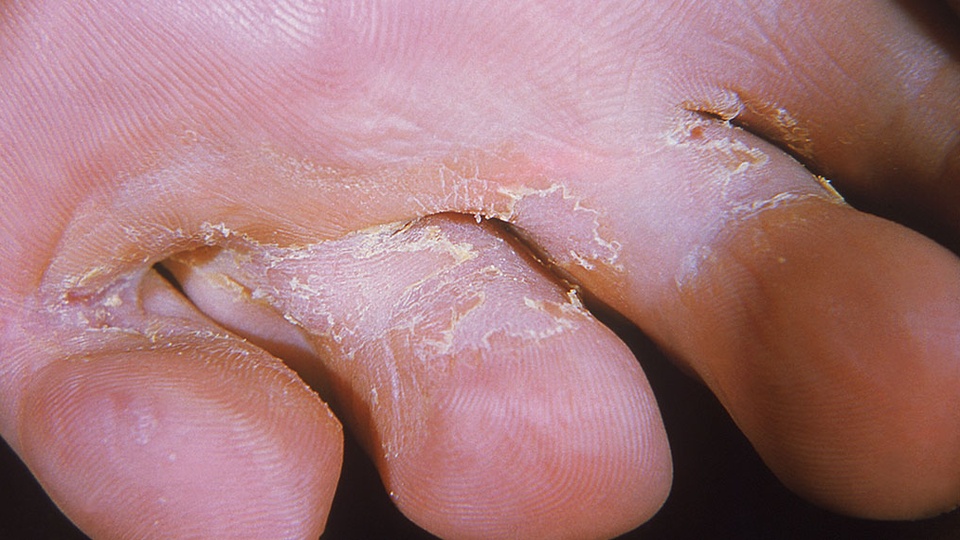 Tinea-pedis © beigestellt