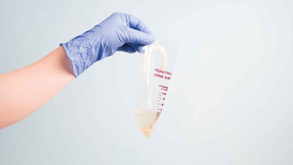 Beutelurin eignet sich nur für eine erste Diagnostik anhand von Urinstreifentests. Für das Anlegen einer Urinkultur ist der Mittelstrahlurin in einem Urinbecher notwendig. © Shutterstock