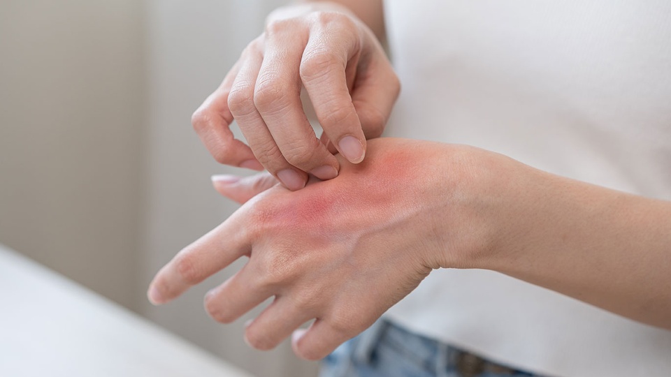 Allergische Reaktion &copy; shutterstock