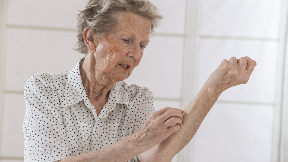 Eine ältere Frau leidet unter Juckreiz und kratzt sich an den Unterarmen. © Shutterstock