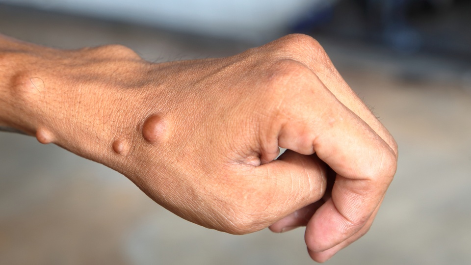 Knotige Tumorbildung auf der Hand. © Shutterstock
