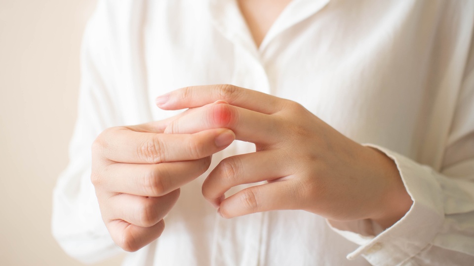 Eine Frau hält ihren geschwollenen Finger in die Kamera. © Shutterstock