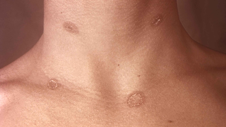 Tinea-corporis © beigestellt