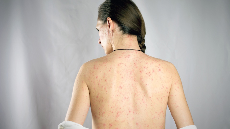 Typischer Hautausschlag bei Infektion mit dem Epstein-Barr-Virus © Shutterstock