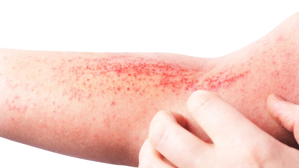 Atopische Dermatitis © Shutterstock