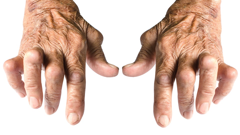 Arthritis © Shutterstock