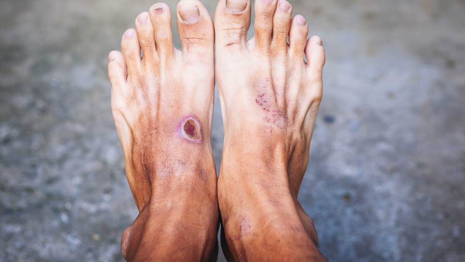 Hornhautschwielen durch ungeeignetes Schuhwerk, Fuß- und/oder Zehenverformungen und Adipositas sind nur einer der Risikofaktoren des DFS. © Shutterstock