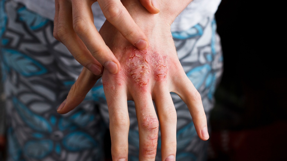 Atopische Dermatitis © Shutterstock