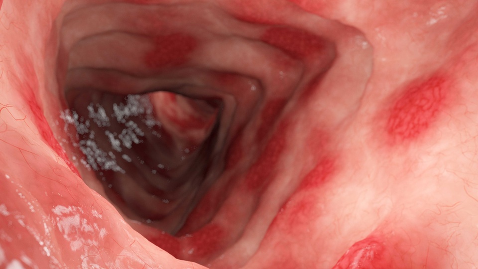 Colitis ulcerosa © Shutterstock