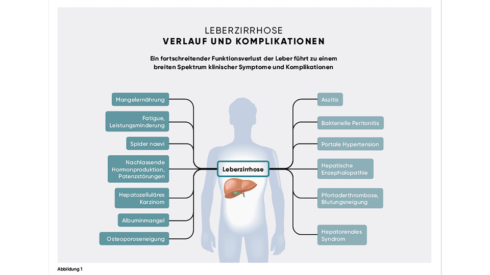 Leberzirrhose © Beigestellt