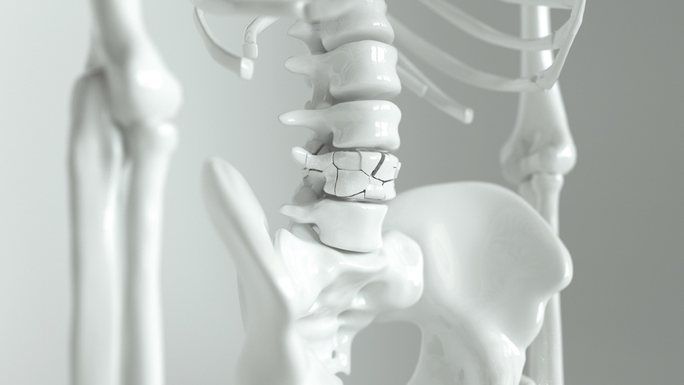 Osteoporose © Shutterstock