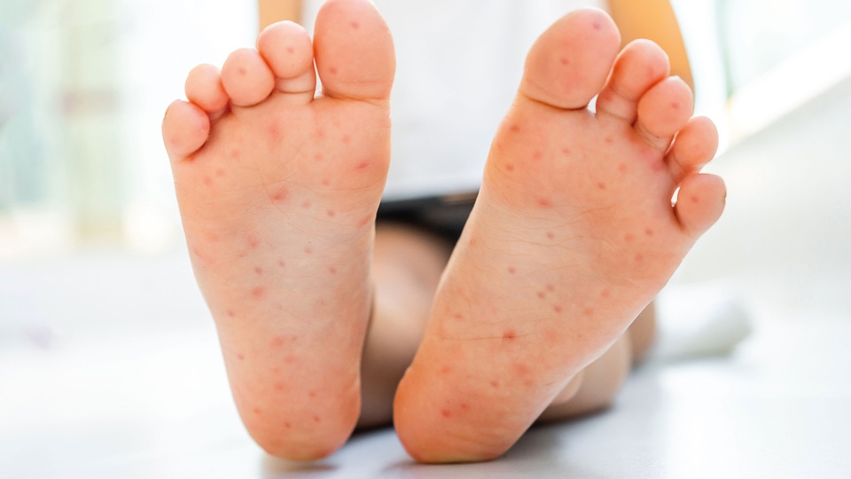 Hand-Fuß-Mund-Krankheit © Shutterstock